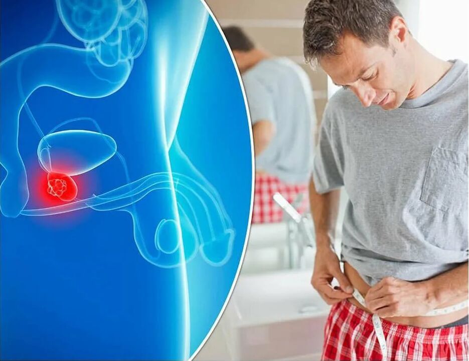 simptomi in vzroki za prostatitis