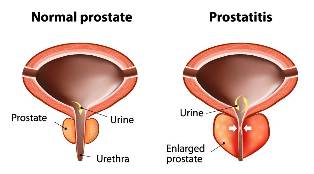 akutni prostatitis zdravljenje