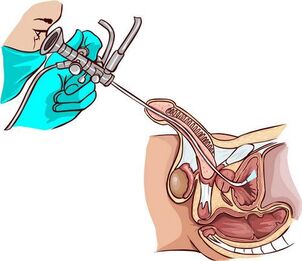 Postopek ureteroskopije